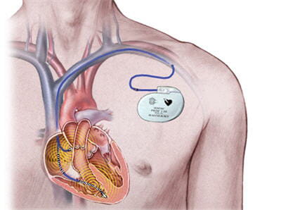 système de pacemaker