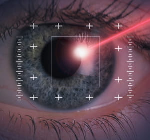 sans effet secondaire, le lasik a démocratisé la chirurgie de la myopie.