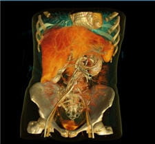 l'imagerie médicale, en 3d, très convaincante